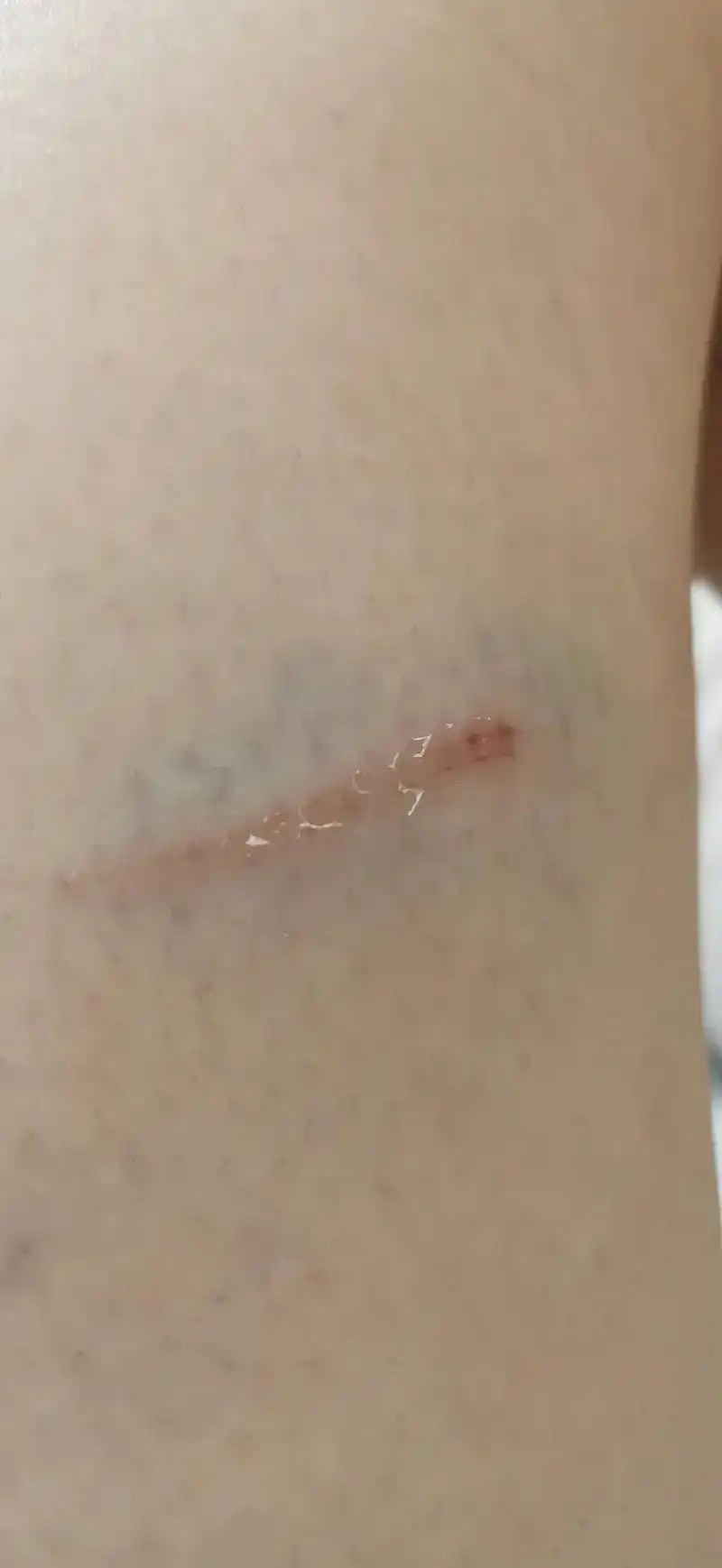 腿磕在了桌角,当时疼了一下,晚上下班后发现腿淤青一片.还有些 - 抖音