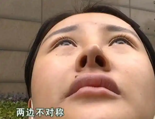 整容之后发现鼻子歪了找医院退钱院长没有肿的像猪头不退