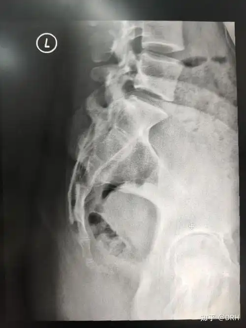 骶尾椎影像报告怎么写? - 知乎