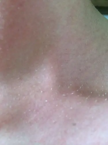 脖子上长了白色的