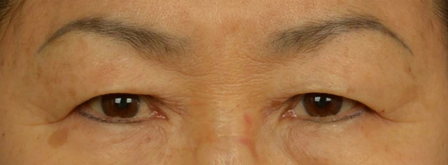 吕晓杰眼皮松弛下垂的三种情况每一种都能拉低颜值