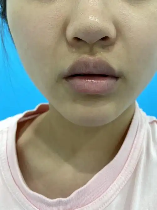 大家也看的到我的上下唇都是比较厚的,没有任何形状可_圈子-新氧美容