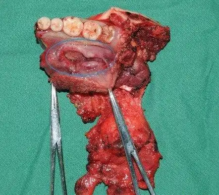 口腔颌面部肿瘤_口腔颌面部肿瘤治疗方式 - 好大夫在线