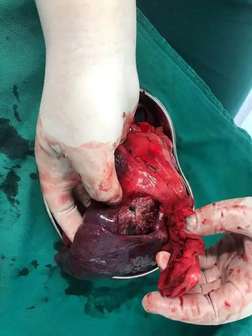 我院外四科完成首例右全肺切除术