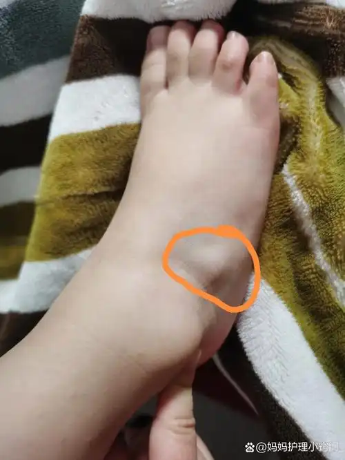 2岁宝宝脚踝处凸出来一个硬包