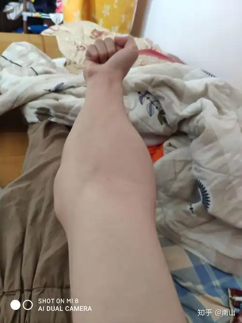 肘外翻是一种怎样的体验 如图?