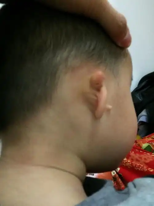 3岁宝宝耳朵畸形,治疗整形费用需要多少,该去什么医院治疗比较好.