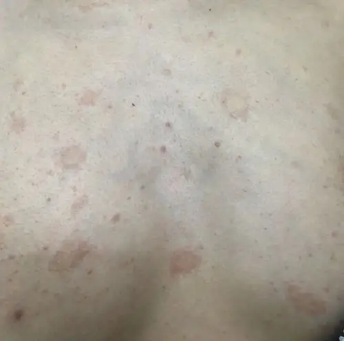 胸膛上面长这种一块一块的红斑是怎么回事?
