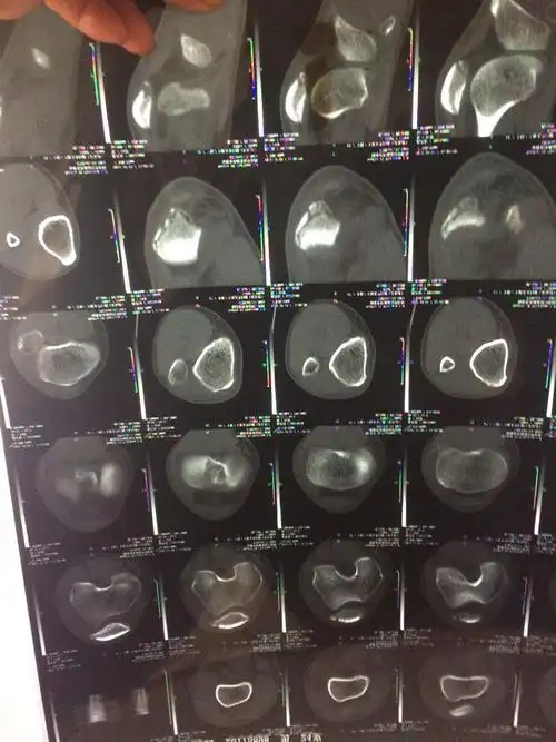 长骨痂了吗?长得怎么样?可以拆石膏了吗?保守治疗石膏外固定的!