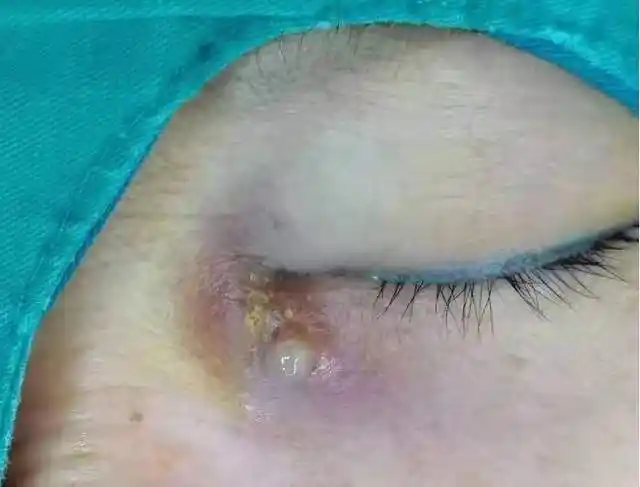 大妈眼角红肿破溃原是泪囊炎急性发作