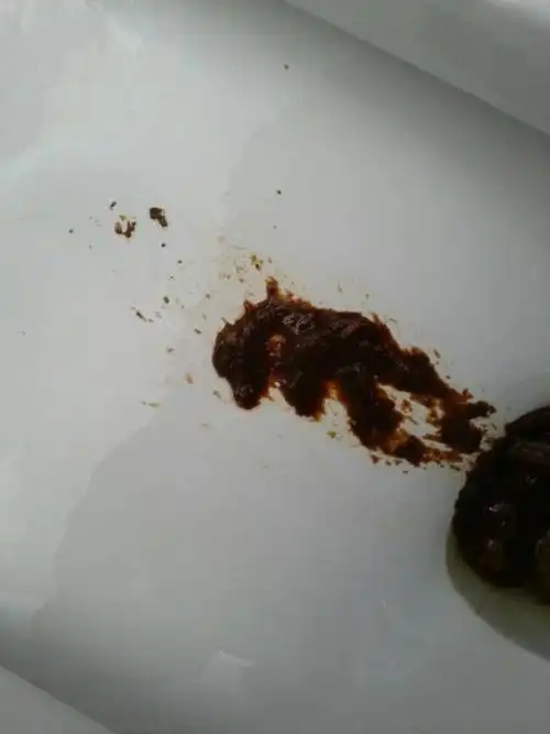 大便偶尔这种颜色有什么问题? 由于拍照问题,颜色没有红,是深褐色