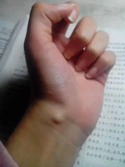 手腕上有个小包不知道是什么也不疼前
