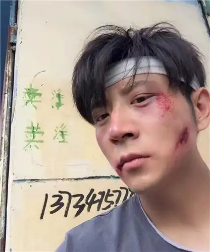 高晓攀被揍至鼻青脸肿 难挡气质有疤也帅(图)