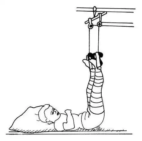 二,双下肢悬吊牵引一,下肢皮套牵引常用皮牵引有以下几种方式四皮牵引