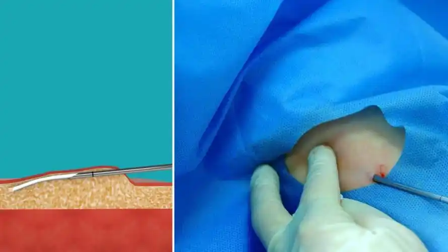 左炔诺孕酮皮下埋植剂植入介绍 - 新片场