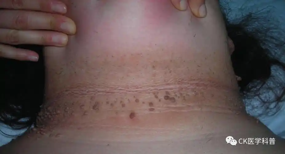 图像速览|内分泌疾病皮肤表现:黑棘皮病_黑棘皮病_医脉通
