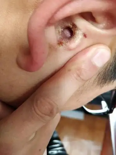 耳多流脓,偶尔很痒,用什么药治好