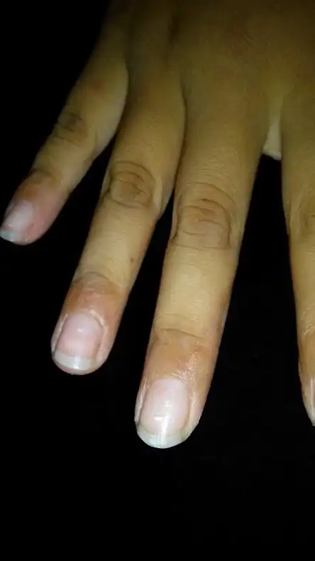 十岁男孩指甲泛白点,请问是身体缺啥吗?非专业勿喷.