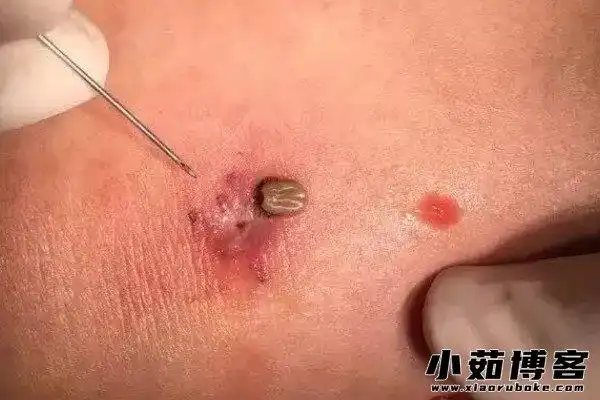 蜱虫咬人后的伤口图