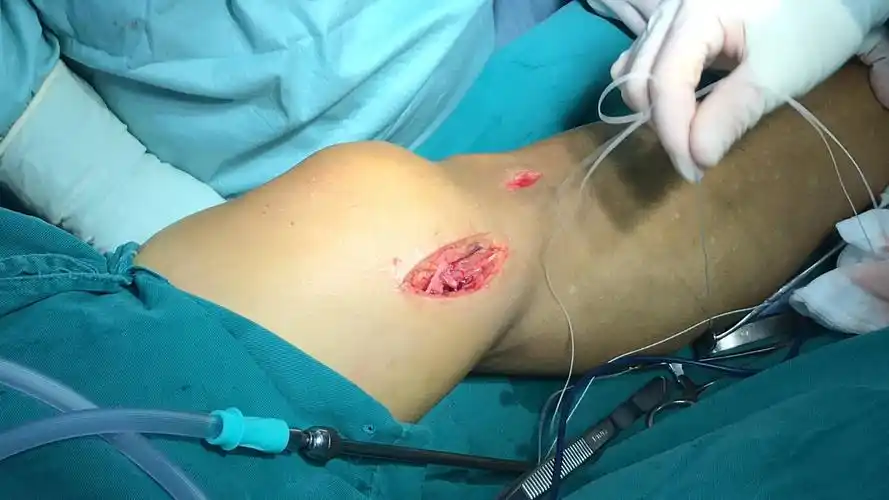 膝关节内侧付韧带重建