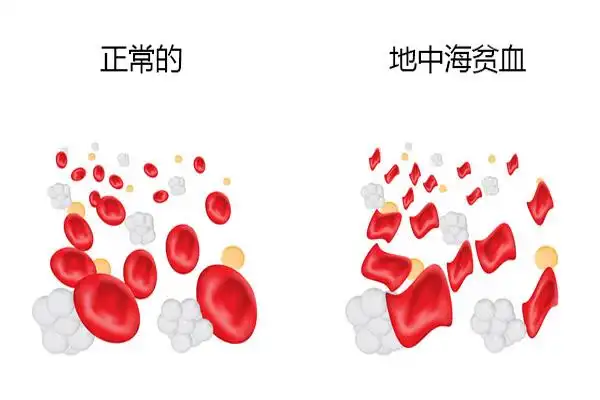 地中海贫血发作,地中海贫血发作症状,振东健康