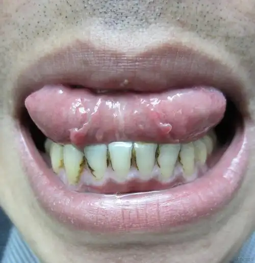 谁治疗过此病,舌系带息肉?