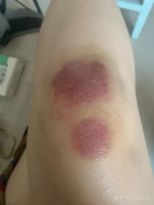 骑电动车擦伤恢复过程