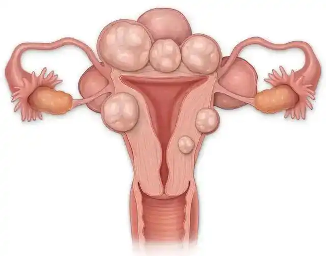 卵巢癌,宫颈癌等,在经过医生慎重评估后需要进行全子宫切除术的