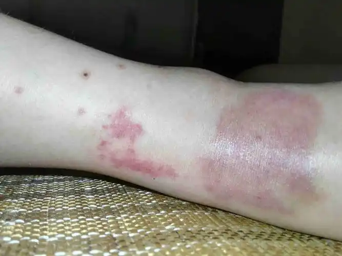 急,急,小孩被虫咬了,腿上又痛又肿还出现一块血斑