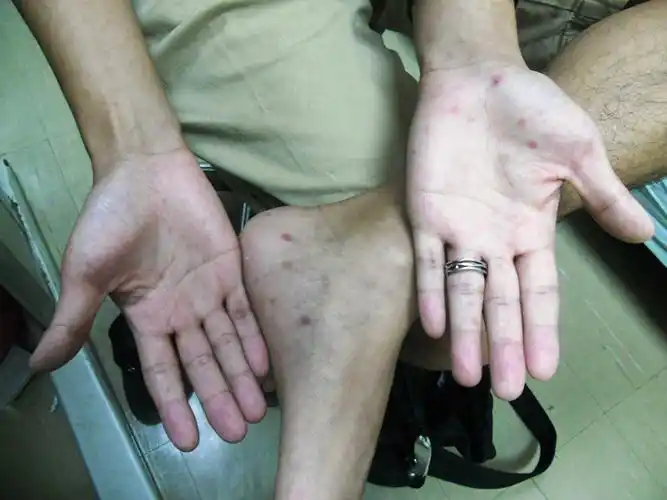 一期梅毒图片——肛门部硬下疳图片_有来医生