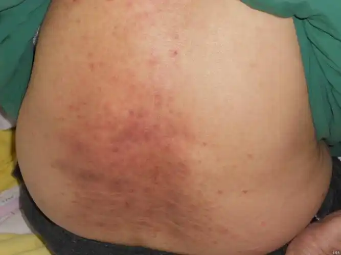 和!湿疹图片初期症状图"多福多寿"-第1张图片-渝北博客