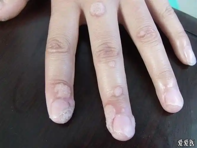 多发性寻常疣和甲周疣4楼最后的脱落完毕
