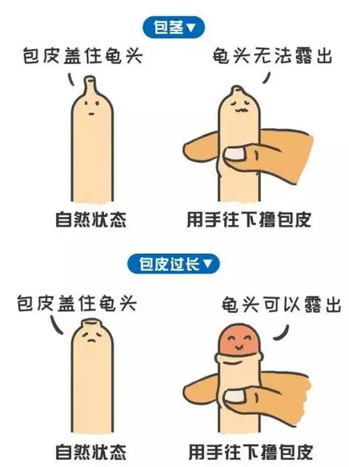 "小弟弟"爱美丽,早早"出人头地"_包皮_手术_阴茎