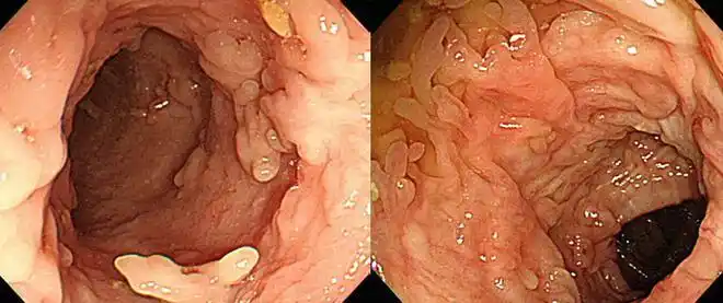 炎症|腺瘤|直肠_网易订阅