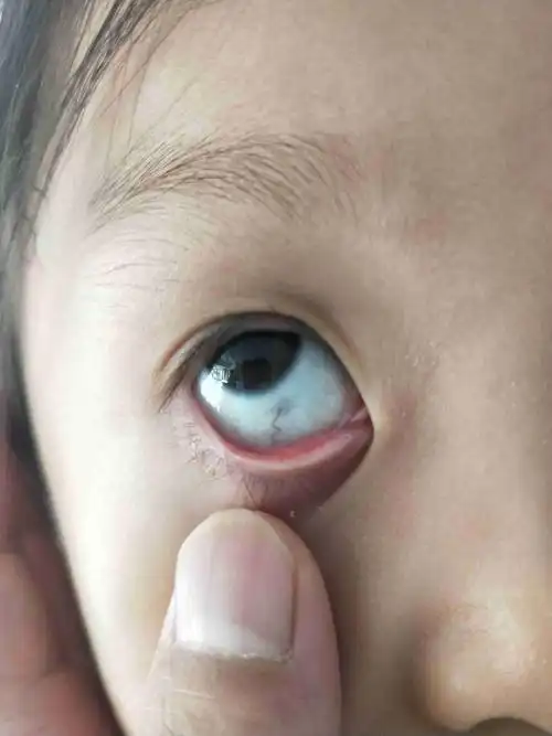 孩子的眼镜总是起麦粒肿 !眼睛里这是什么?去医院医院说好着呢!