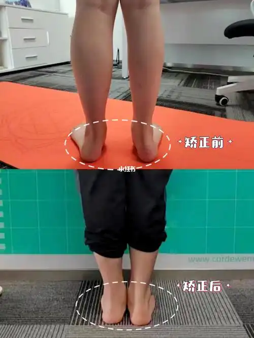 13岁孩子足外翻矫正一年的变化