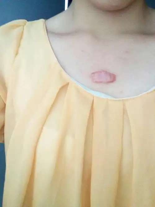 2011年做了一个小手术,留下一个增生性凹凸疤痕,在胸前,经常会痛会痒.