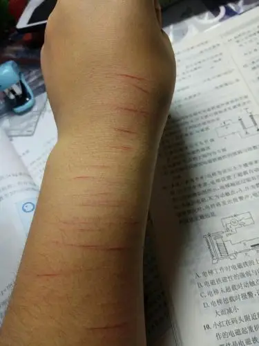我喜欢上了自残 而且控制不住自己 我该怎么办 虽然伤口不严重