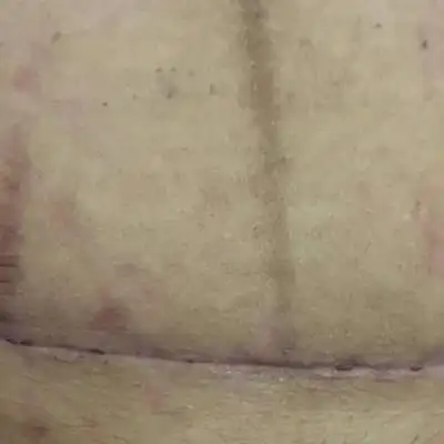 我是破腹产的,20天了,可以洗澡了吗?刀疤好了