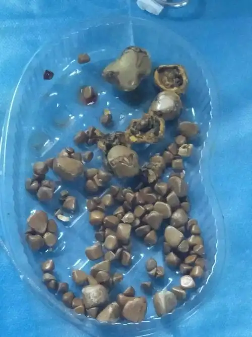 老人取出的胆结石