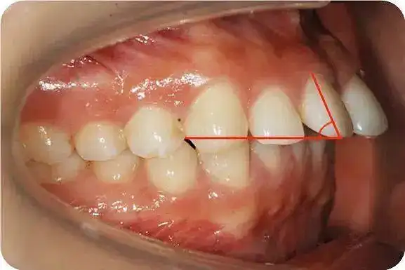 听说龅牙分牙性和骨性骨性龅牙是不是矫正意义不大