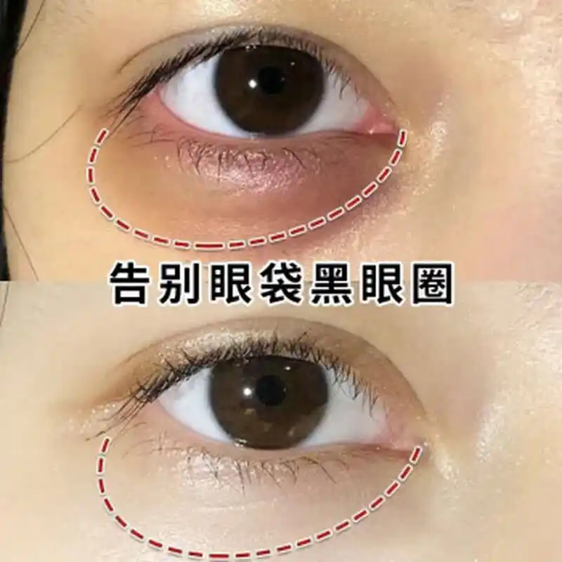 色素型大多以棕色调为主,此类型的黑眼圈大多是由于日晒导致的色素