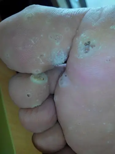 你好医生,我的右脚从去年夏天起在第一和第二个脚趾头处,长出一些肉刺