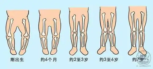 蹲起,下肢承受的重量增加,"o"型腿会逐渐改善;等到2岁之后,多数孩