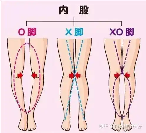 卢九宁讲腿型干货:x型腿,o型腿,xo型对我们有哪些影响?