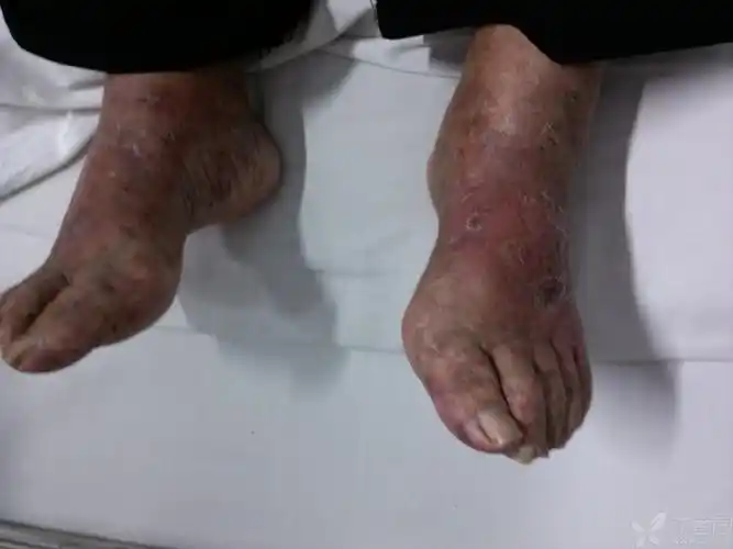 【求助】网状青斑?前辈给看一下,谢谢!