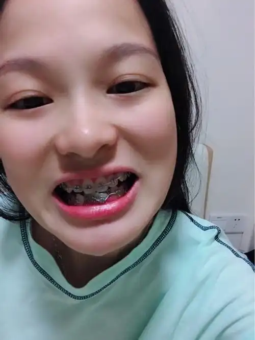 牙套77天纠结要不要拔牙,感觉牙齿外凸了.