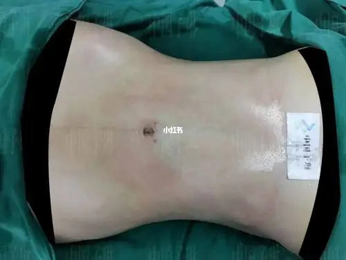 威塑腰腹环吸_腰腹_吸脂_减肥_减肥医药