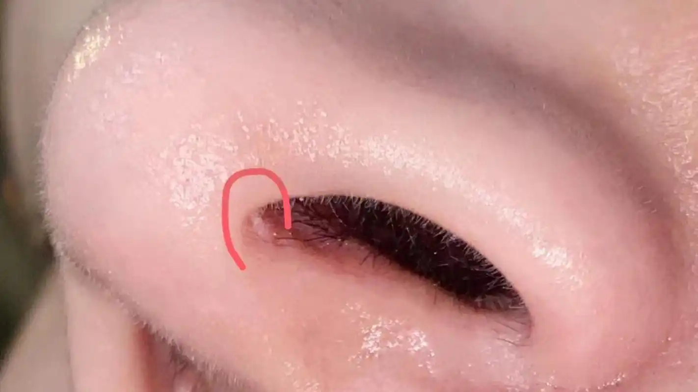 肋软骨隆鼻疤痕增生如何处理?