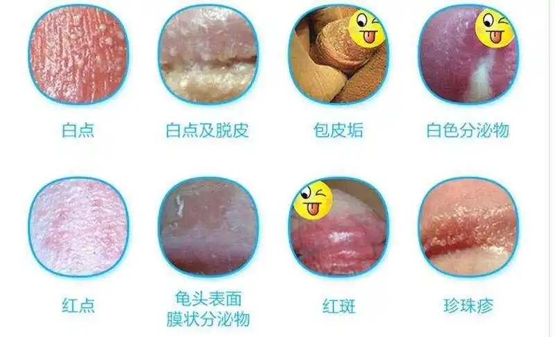 龟头敏感怎么治疗?